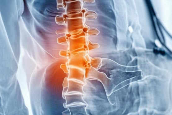 Lumbar Spondylosis
