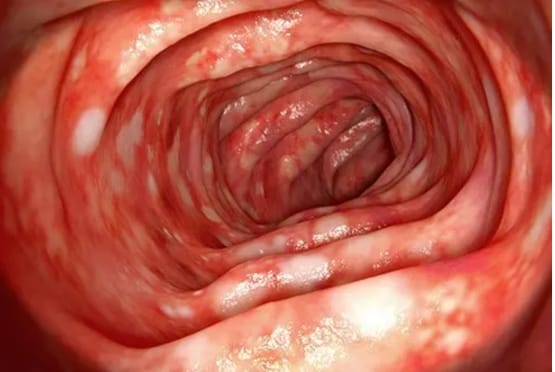 Ulcerative Colitis