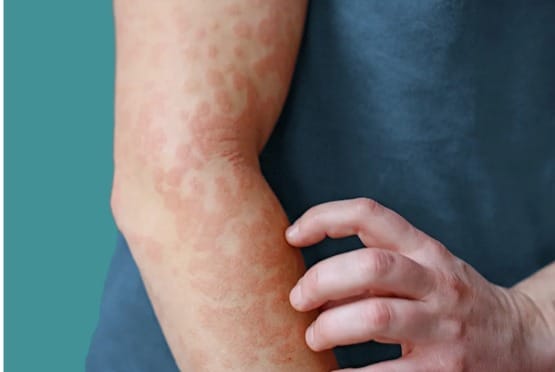 Urticaria